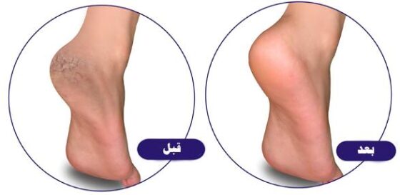 افضل الطرق الطبيعيه لعلاج تشقق القدمين