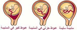 اعراض انفصال المشيمه