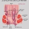 اعشاب طبيه للتخلص من الشرخ الشرجي والنزف للبواسير